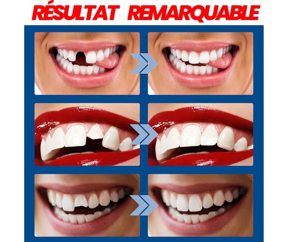 🦷 Gel Dentaire Moulable : Retrouvez Votre Sourire en Quelques Minutes ! Votre Sourire Mérite d'Être Complet